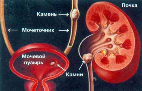 Почечная колика причины