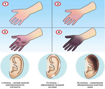 Первая помощь при обморожении